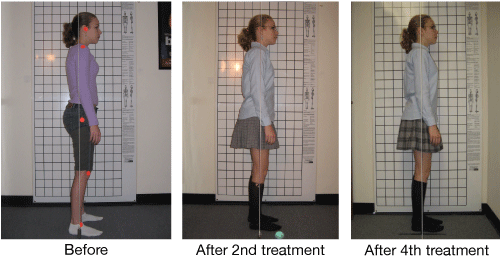 Three images of the side view of a teenage girl standing in front of a grid in a medical office. In the first picture, orange dots on her head, shoulders, hips, knees, and feet show how twisted and out of alignment her body is. In the next two pictures she is gradually straighter.